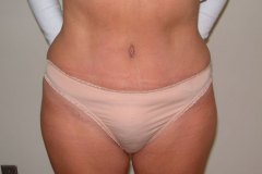 Liposuction Patient 1 Front After