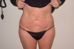 Liposuction Patient 1 Front Before