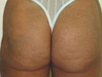 Liposuction Patient 3 Rear After