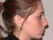 Rhinoplasty Surgery Patient 1 Right After