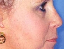 Rhinoplasty Surgery Patient 2 Right After