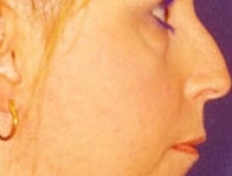 Rhinoplasty Surgery Patient 2 Right Before