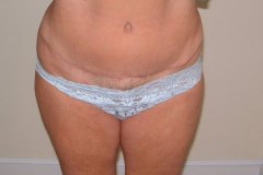 Tummy Tuck Patient 1 Front After
