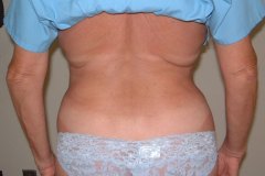 Tummy Tuck Patient 1 Rear After