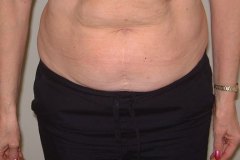 Tummy Tuck Patient 1 Front Before