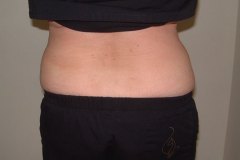 Tummy Tuck Patient 1 Rear Before