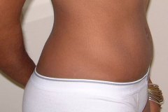 Tummy Tuck Patient 2 Right After