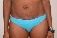 Tummy Tuck Patient 2 Front Before