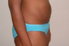 Tummy Tuck Patient 2 Right Before