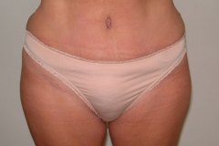 Tummy Tuck Patient 3 Front After