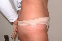 Tummy Tuck Patient 3 Right After
