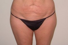 Tummy Tuck Patient 3 Front Before