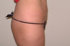 Tummy Tuck Patient 3 Right Before