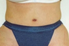 Tummy Tuck Patient 4 Front After