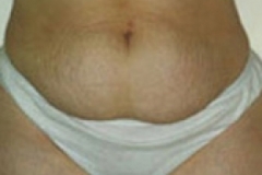 Tummy Tuck Patient 4 Front Before