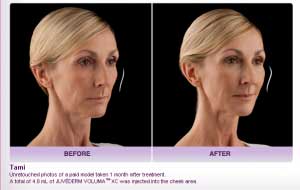 Before-and-After-JUVÉDERM®-VOLUMA®-XC