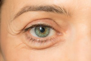 What Causes Bags Under the Eyes, and What Can I Do About Them