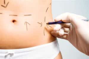 belly-being-marked-for-surgery