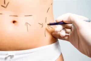 marking-waist-for-Tummy-Tuck-Surgery